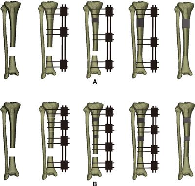 Bone Defects in Tibia Managed by the Bifocal vs. Trifocal Bone Transport Technique: A Retrospective Comparative Study